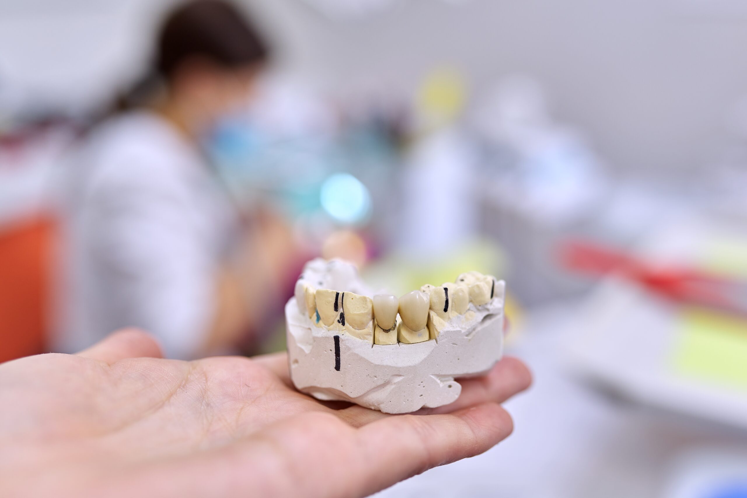 gypsum model of teeth of jaw with ceramic crowns